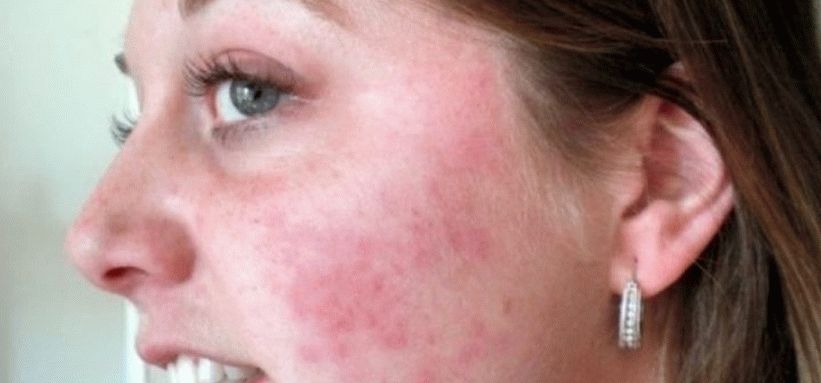 Milyen betegségre utalnak a vörös foltok? - HáziPatika
